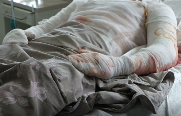  У Мукачеві до лікарні потрапив мешканець Страбичова з 36% опіків тіла 